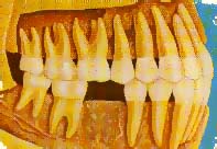 loss of the first molar