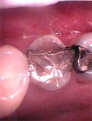 fractured tooth