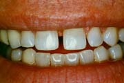 spacing between teeth before bonding