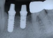 xray with implants integrated with the bone