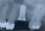 xray with implants integrated with the bone