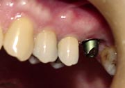 implant post