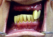 partially edentulous maxilla