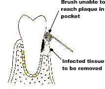 plaque inaccessible to brushing