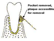 reduction of pocket-plaque is accessible