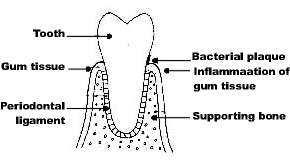 tooth, bone, and gums