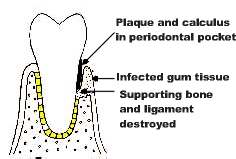 bone lose and pocket formation