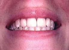the four teeth restored with porcelain veneers