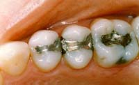 three teeth restored with amalgam